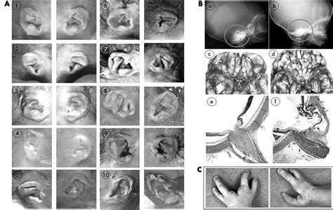 Phenotypic Spectrum Of Charge Syndrome In Fetuses With Chd7 Truncating