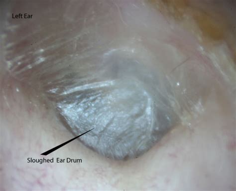 Ear Wax Images Mcgovern Medical School