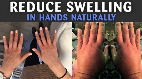 How To Reduce Swelling In Hands Naturally How To Reduce Swelling In Hands Fast With Home