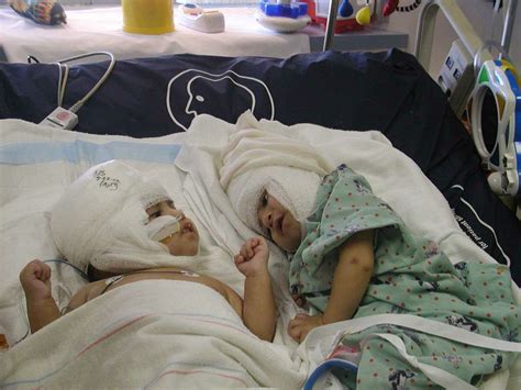 Formerly Conjoined Twins Reunite With Their Hospital Team Ucla