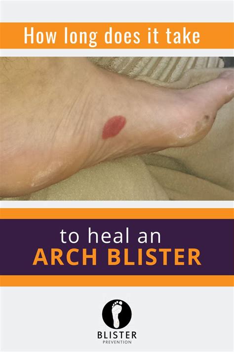 How Long Does It Take To Heal An Arch Blister Read This Blog To Know