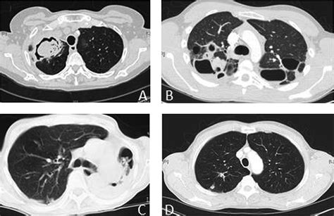The Clinical Spectrum Of Pulmonary Aspergillosis Thorax