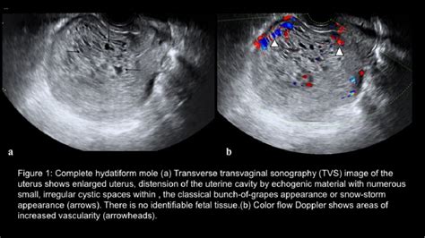 Figure 1 From Ultrasound And MRI Findings In Gestational Trophoblastic