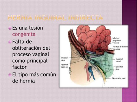 Ppt Hernia Inguinal Powerpoint Presentation Free Download Id2097299