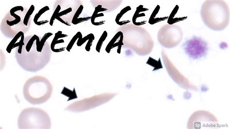 Sickle Cell Anemia Under The Microscope Peripheral Blood Smear Youtube
