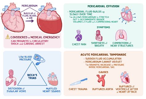 Osmosis Pericardial Tamponade What Is It Causes Pericardial Effusion Signs Diagnosis