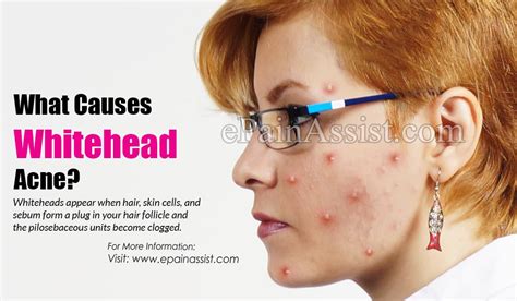 What Causes Whitehead Acne And How To Get Rid Of It Picture