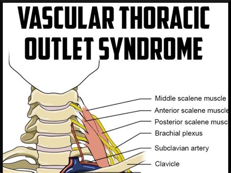Cervical Rib Removal Surgery For Thoracic Outlet Syndrome Givealittle