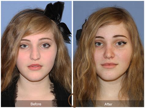 New apps replicate the results of plastic surgery without taking the plunge. Teenage Nose Job | Gallery Of Cosmetic Surgery Orange ...