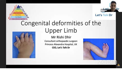 Congenital Deformities Of The Upper Limb —