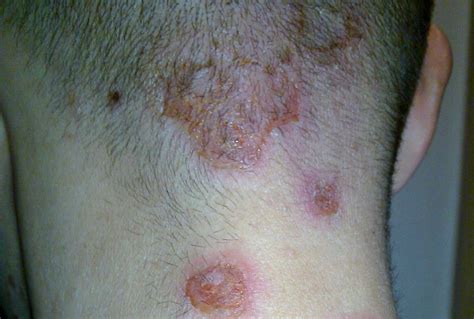 Infections As Related To Impetigo Pictures