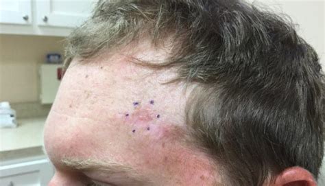 Mohs Case Recurring Basal Cell Carcinoma In Young Patient
