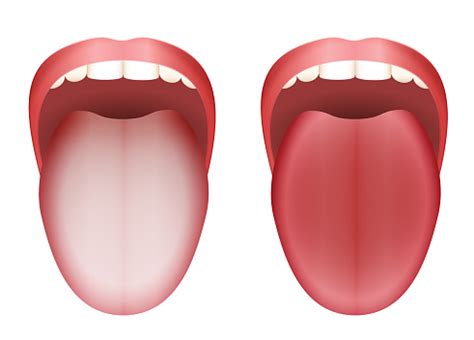 How to brush your tongue: Coated White Tongue And Clean Healthy Tongue By Comparison ...