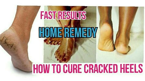 How To Cure Cracked Heels Fast Home Remedy Dry And Painful Cracked