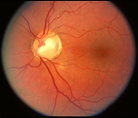 Optic Nerve Pit Two In One Nerve Retina Image Bank