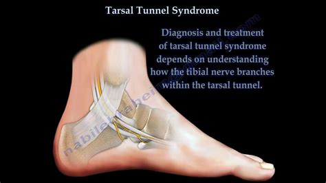 Tarsal Tunnel Syndrome Everything You Need To Know Dr Nabil