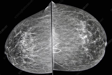 Can U See Breast Cancer On A Chest X Ray ️ Updated Guide 2022