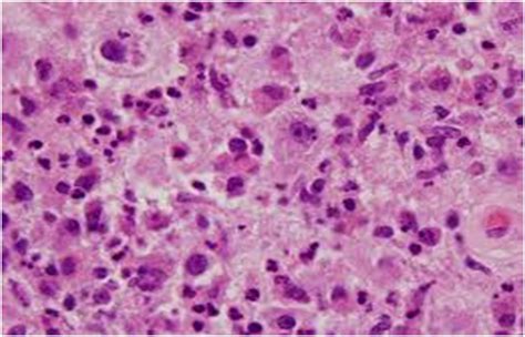 Phagocytosis And Emperipolesis Rosai Dorfmans Syndrome