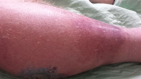 Bubbamikes Ramblings Cellulitis Warning Graphic Photos In This Post