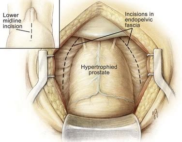 Retropubic And Suprapubic Open Prostatectomy Abdominal Key