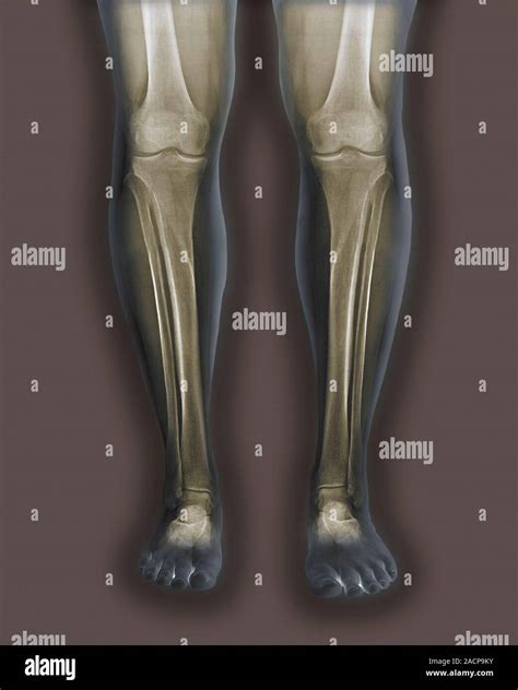 Normal Legs Coloured Frontal X Rays Of The Healthy Legs Of A 35 Year