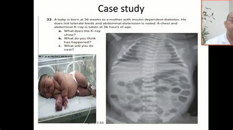 Case 113 Absent Rectal Gas Small Left Colon Syndrome Idm Infant Of
