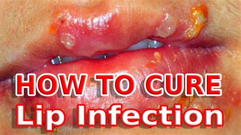Chronic red irritated lips fungal infection? answered by dr. Home Care For Lip Infection - YouTube