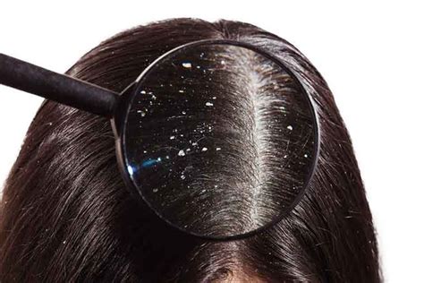 10 Best Ways On How To Get Rid Of Dandruff Naturally At Home Dandruff