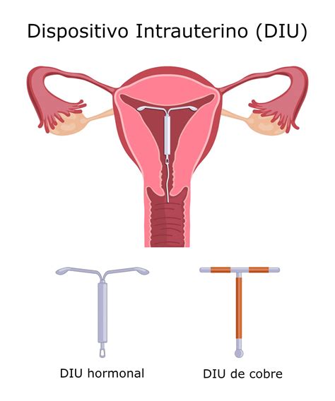 Dispositivo Intrauterino Diu Tipos Efic Cia Formas De Inser O