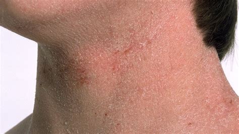 Autoimmune Skin Diseases And Rashes That Affect Appearance Everyday