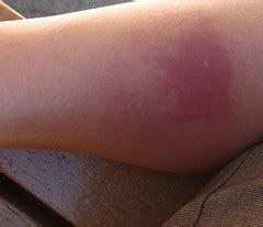 Early stages of a brown recluse bite! Photo of the Day: July 12, 2010 - "Spider Bite?" | Flickr ...