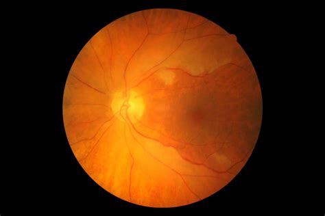 Central Retinal Artery Occlusion2 Eyes Wide Bay