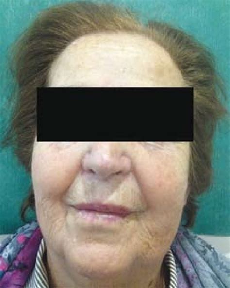 The Patient Presents A Mild Swelling In The Left Side Of Face