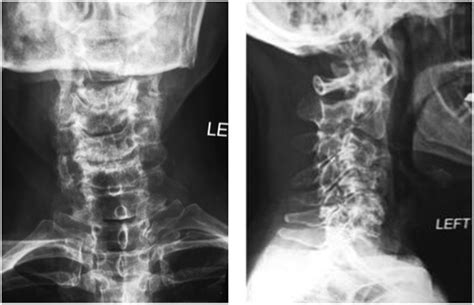 It is very common, and it happens as people get older, and the vertebrae and discs in the neck deteriorate. C4-C7 Spondylosis with Foraminal Stenosis