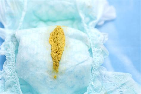 Finding White Poop In Your Breastfed Babys Diaper