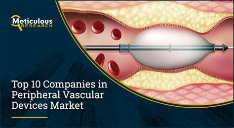 Top 10 Companies In Peripheral Vascular Devices Market Meticulous Blog