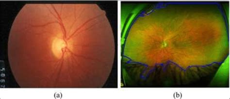 Example Of A A Fundus Image And B An Slo Image Annotated With True