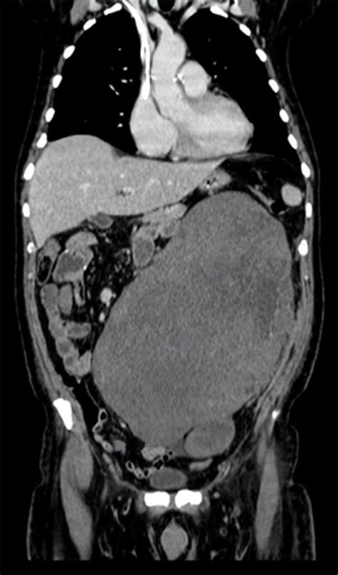 Giant Abdominal Metastasis From Cardiac Liposarcoma Bmj Case Reports
