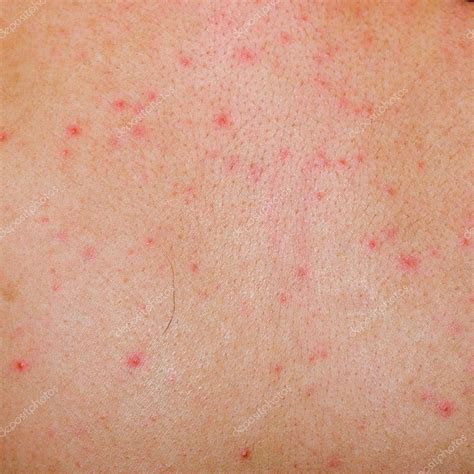 Allergic Rash Dermatitis Skin Stock Photo By ©panxunbin 6926399