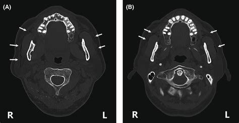 Axial Sections Of A Ct Scan Show Air In Both Parotid Glands And Ducts