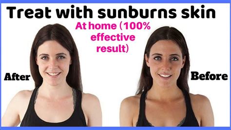 How To Prevent Sunburns Home Remedies For Sunburns Quick Sunburn