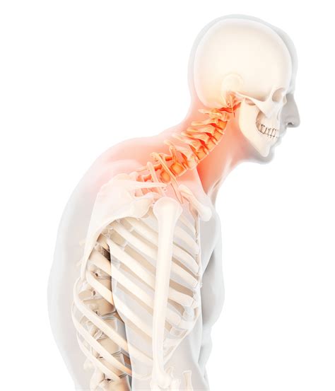 Kyphosis Of Spine Backward Curve The Forbidden Doctor
