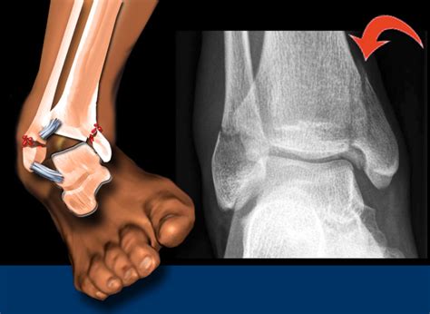 Forced eversion pulls on the medial ligaments, producing an avulsion fracture of the medial malleolus. The Radiology Assistant : Ankle fracture - Weber and Lauge ...