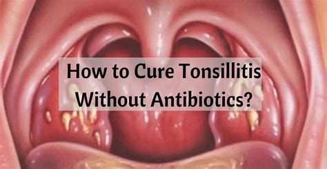 How To Cure Tonsillitis Without Antibiotics A Detailed Overview