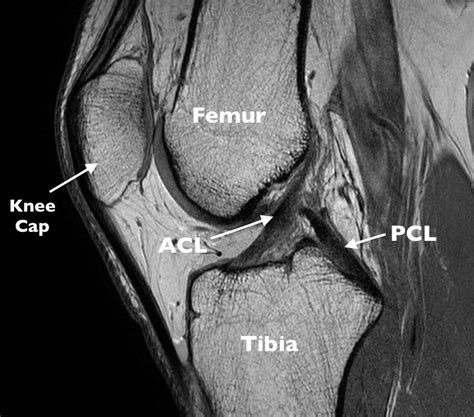 Anatomy Of Knee Mri Figure 6 From Normal Mr Imaging Anatomy Of The