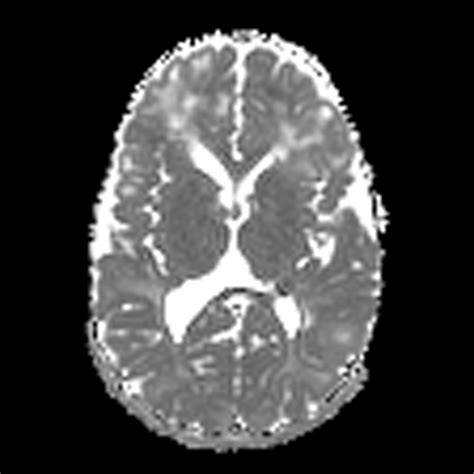 Tuberous Sclerosis Complex With Subependymal Giant Cell Astrocytoma
