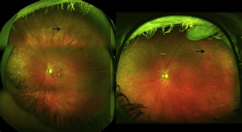 Peripheral Retinal Changes Associated With Age Related Macular