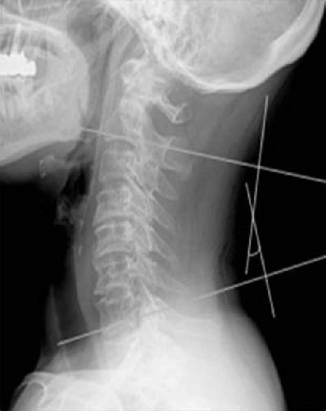 Cobbs Angle For Evaluation Of Cervical Lordosis Is Measured Between