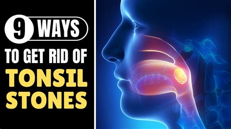 How To Remove Tonsil Stones In Throat At Home Youtube