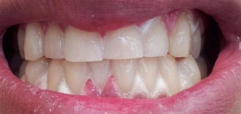 Fancy Getting Your Teeth Whitened You Need To Know This · Thejournalie